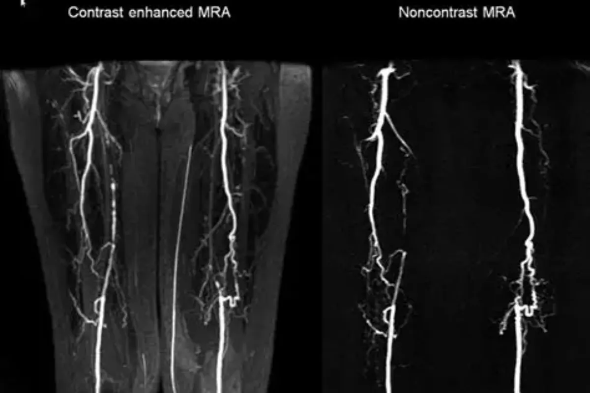 Peripheral Angiography