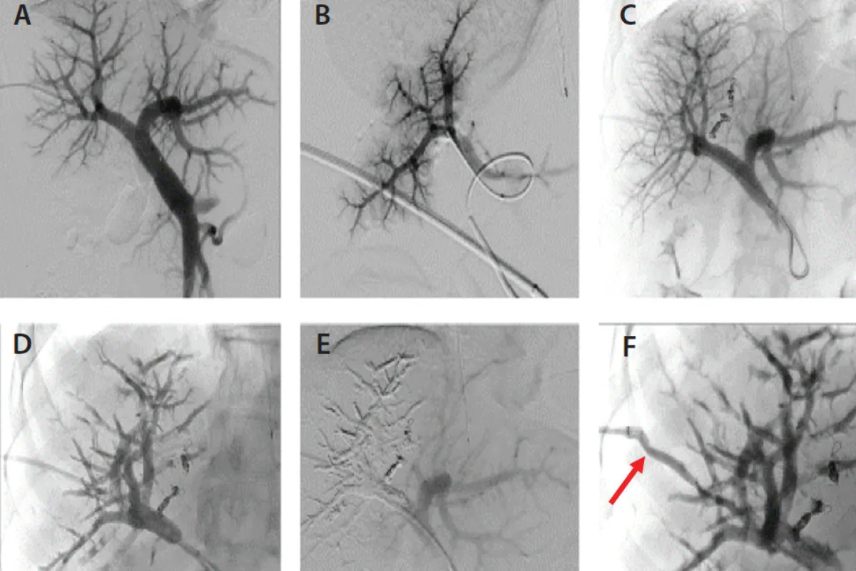 Portal Vein Embolisation