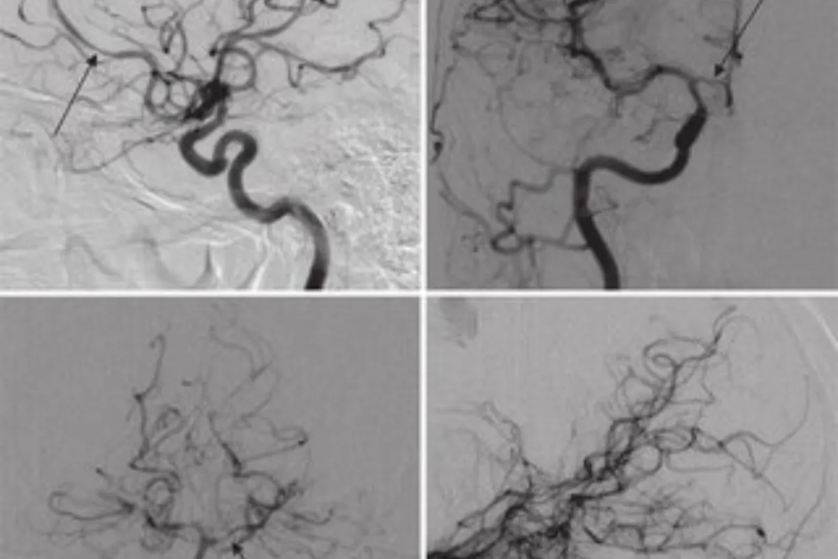 Digital Subtraction Angiography