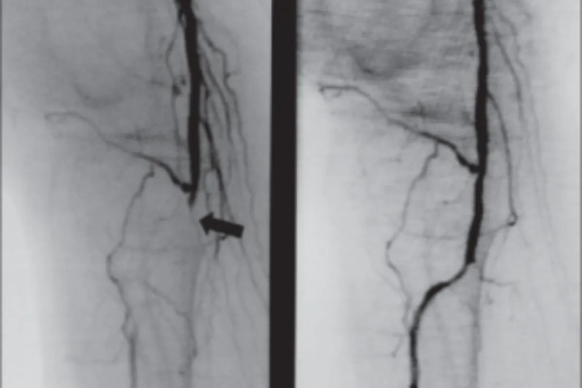 Peripheral Angioplasty & Stenting