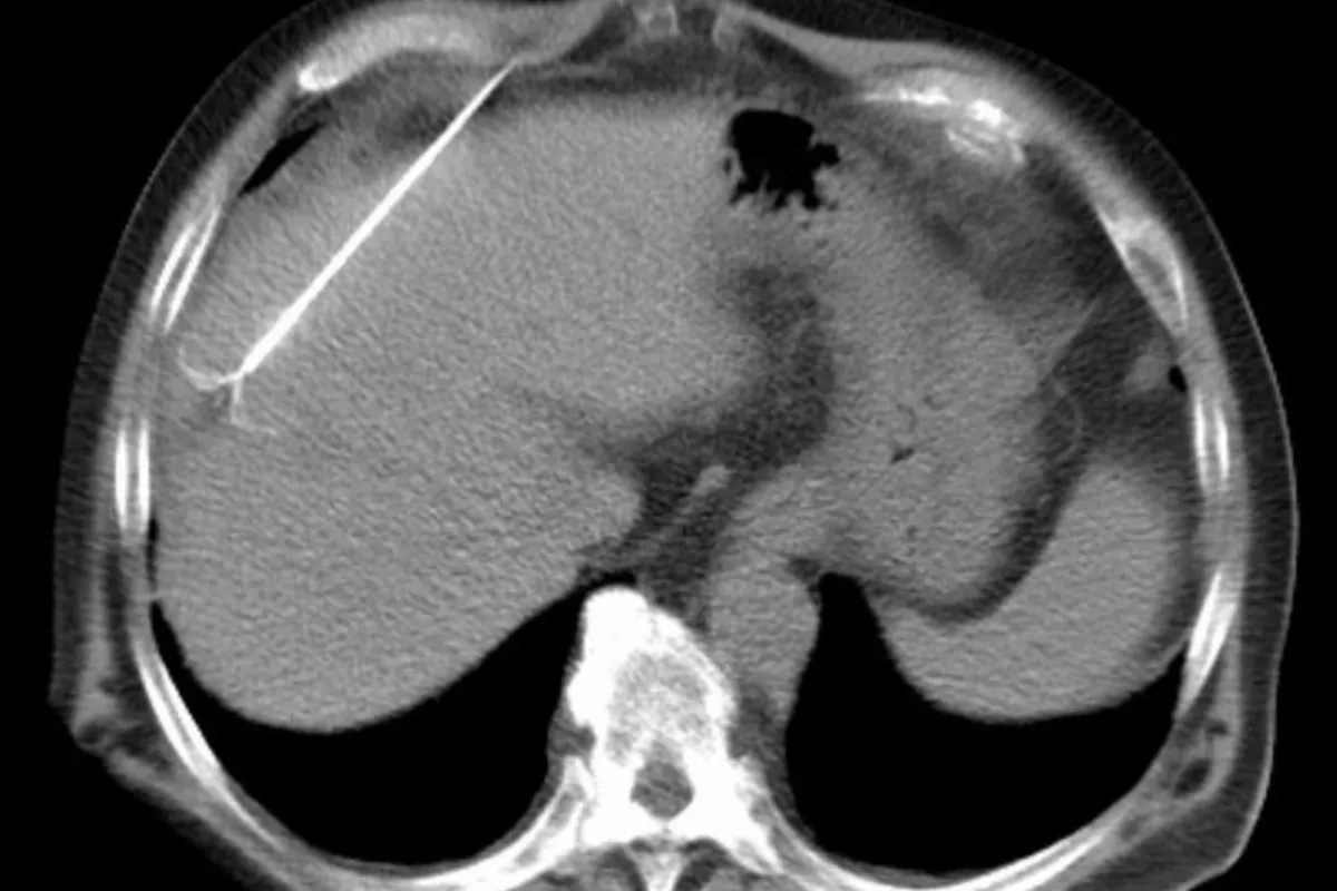 Radiofrequency Ablation 