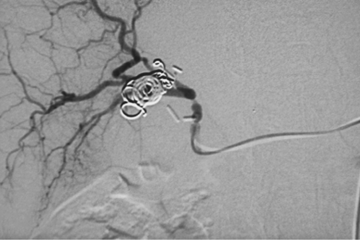 GI Bleeder / Coil Embolisation