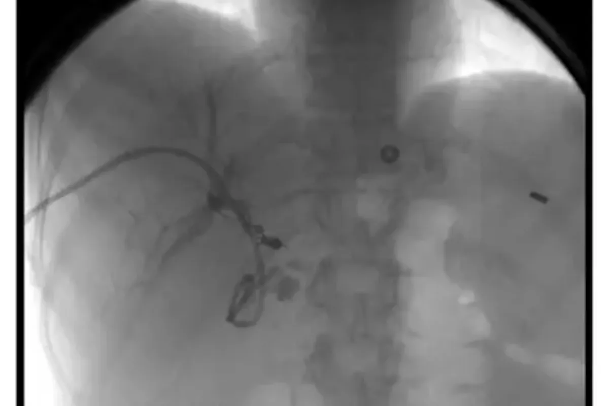 Percutaneous Transhepatic Biliary Drainage