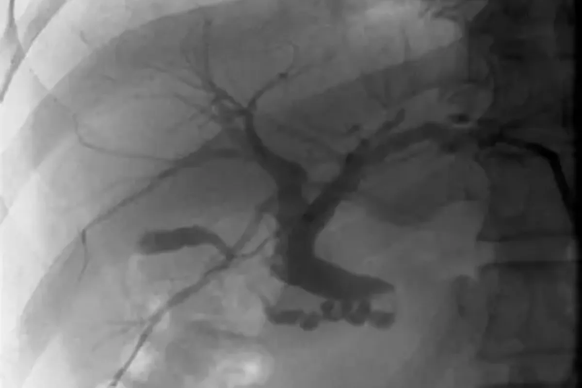 BRTO / PATO / CARTO for Gastric Varices