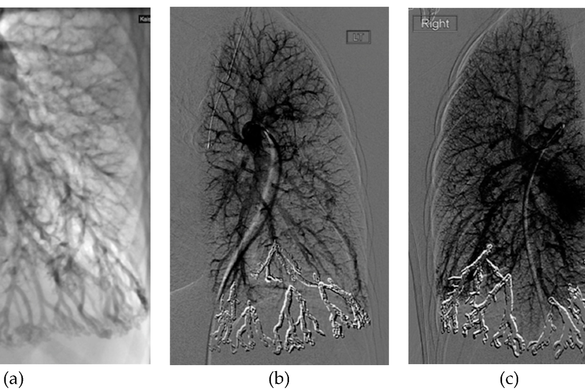 Pulmonary AVF Treatment