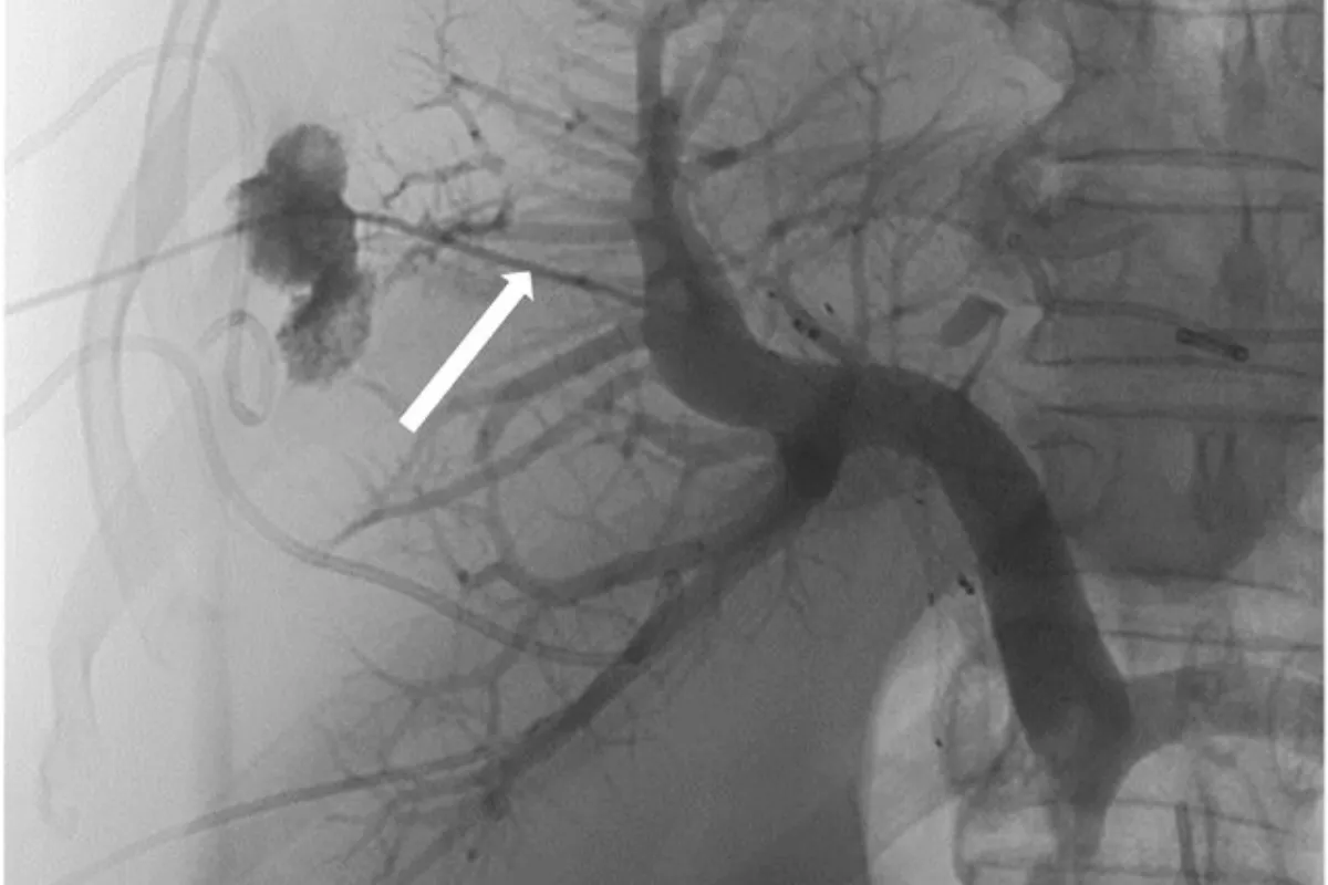 Endobiliary RFA for Cholangiocarcinoma