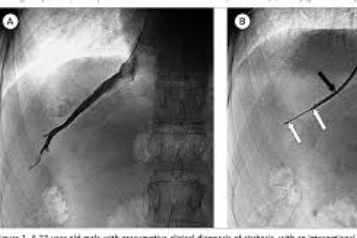 Transjugular Liver Biopsy