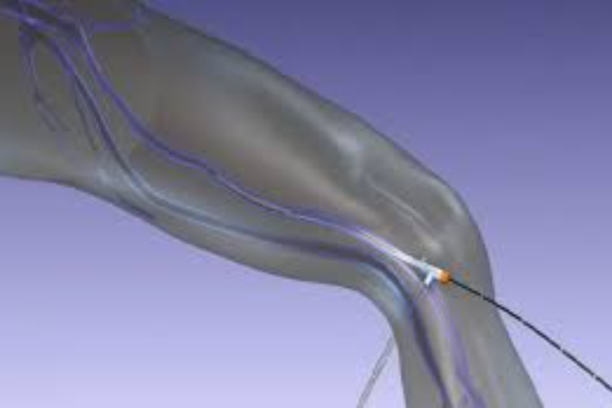 Vericose Vein Treatment Using RFA, Laser, MOCA, Microwave , Venoseal Techniqe