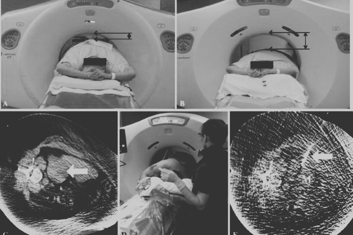 Per Abdominal Biopsy