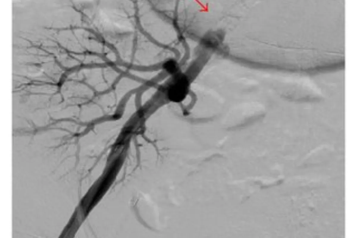 Embolisation Bleeder, Prostatic Artery, Uterine, AVM Renal Artery