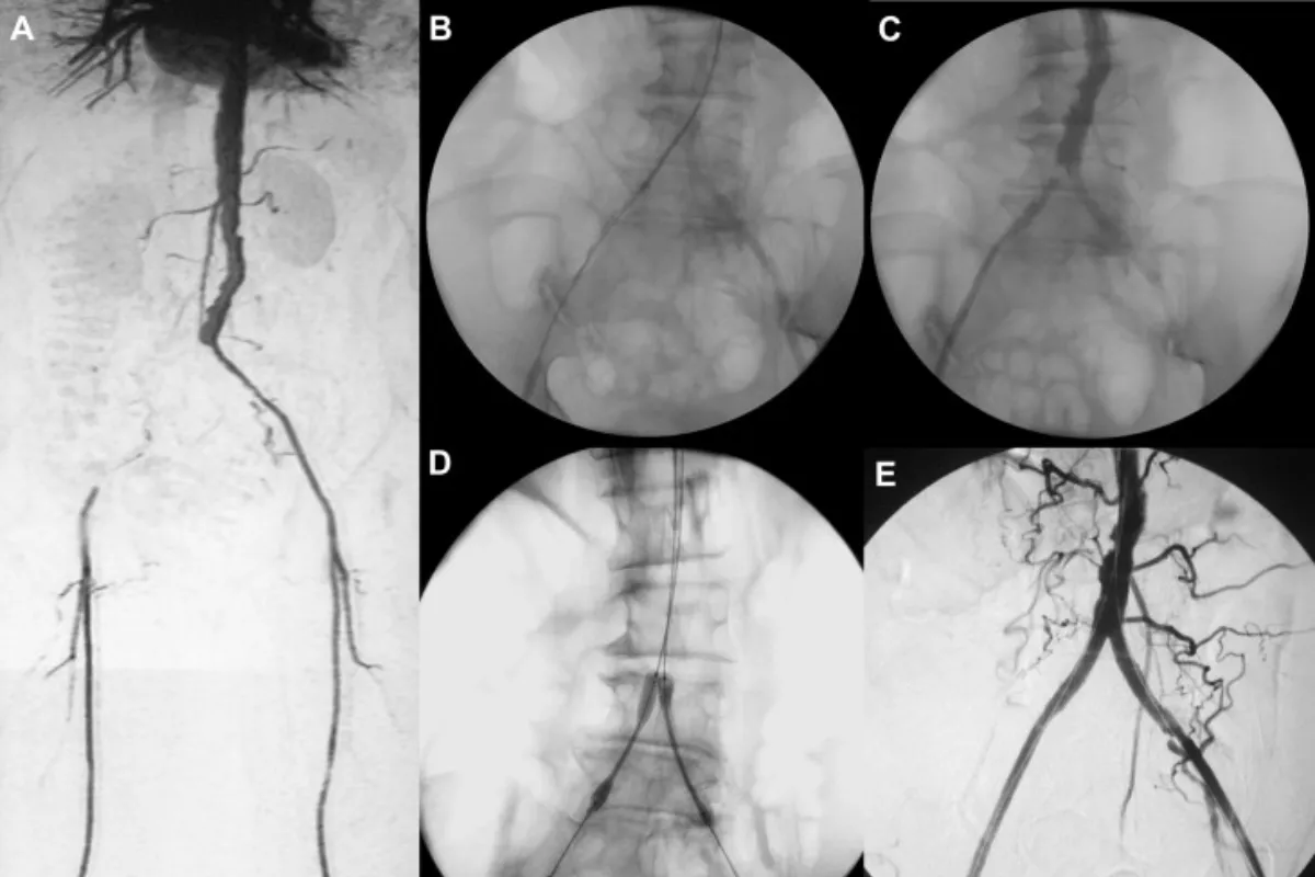 Catheter Directed Thrombolysis