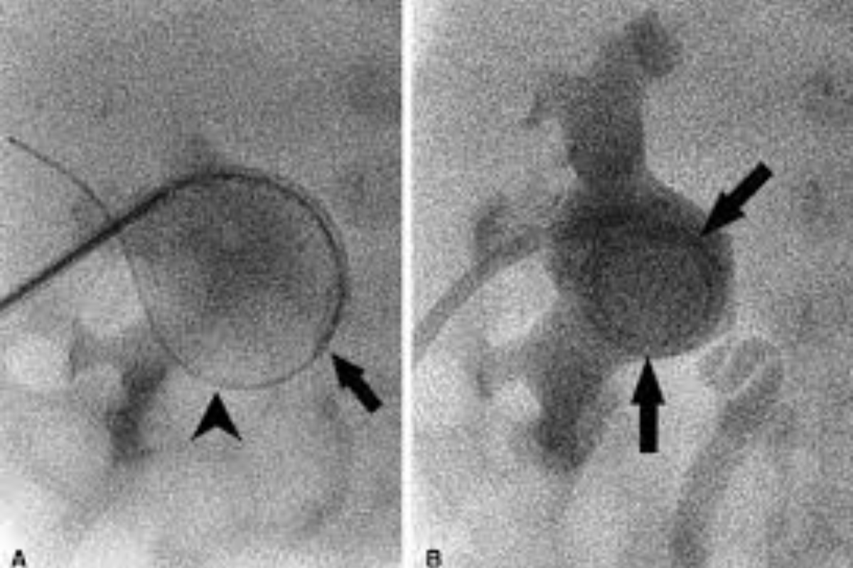 Percutaneous Nephrostomy