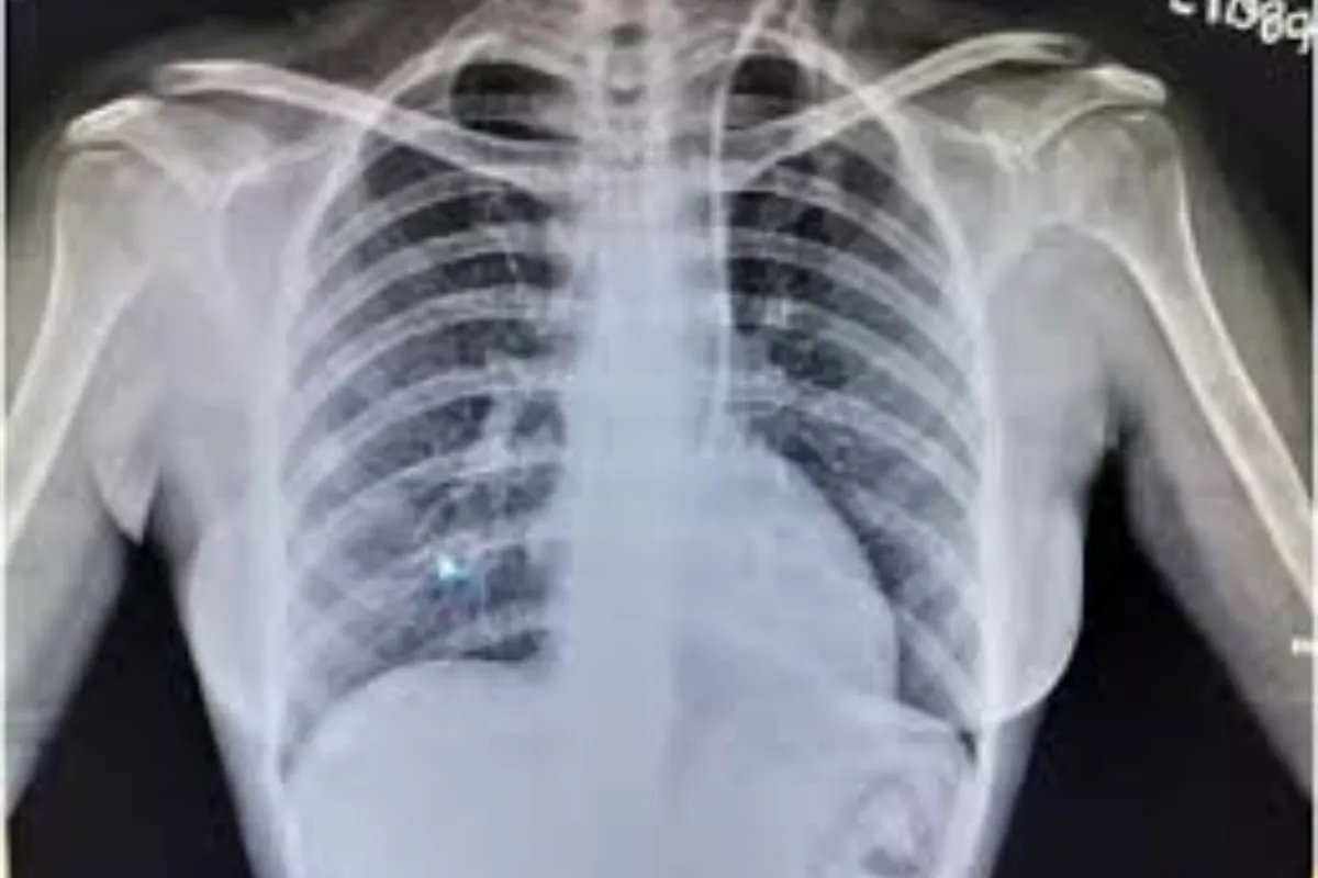 Dialysis Catheter Insertion 