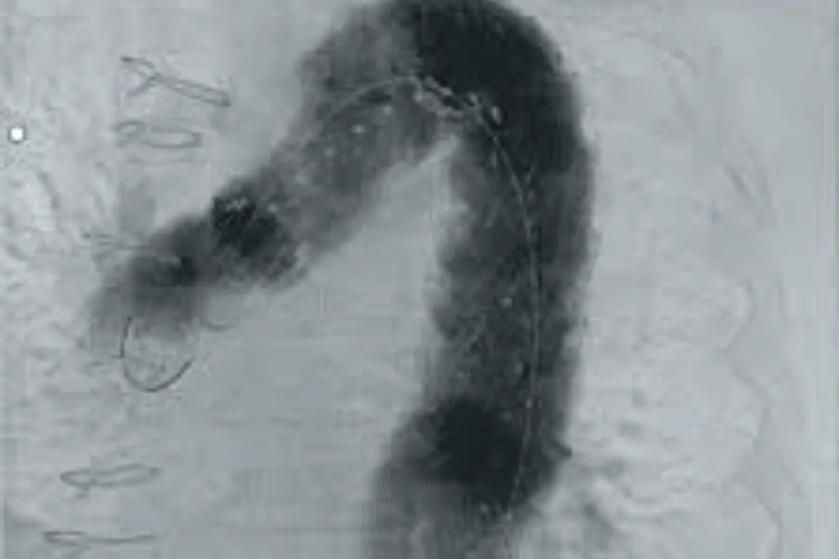 Thoracic Endovascular Aortic Repair (TEVAR))