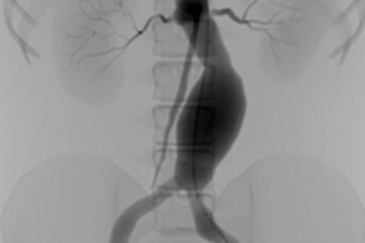 AAA Endovascular Aortic Repair (EVAR)