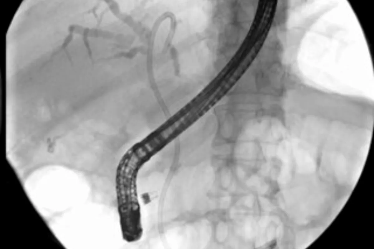 Biliary Stenting